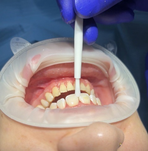 Braces and Aligners