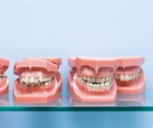 Best Dental Implants Lucknow