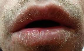 Crusting of Lips - Realtooth