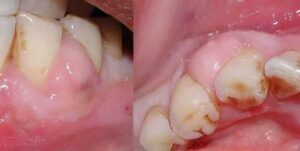 Dental Implants in Lucknow