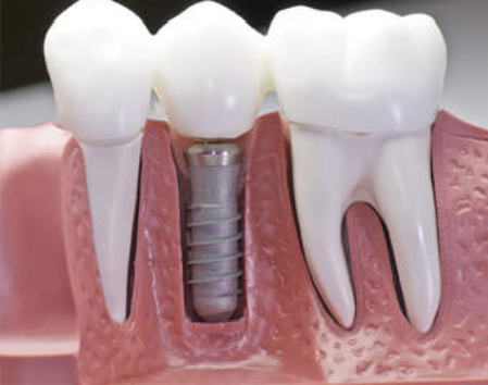 &nbsp;Dental Implants in Lucknow - Realtooth Lucknow