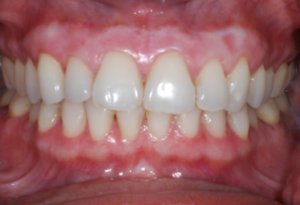 Gum Depigmentation - Realtooth Clinic in Lucknow