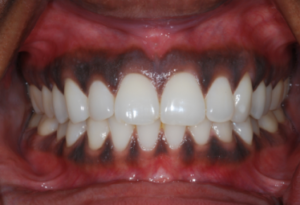 Gum Despigmentation - Realtooth, Lucknow, Dental Solution