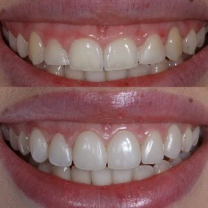 Gum Lift - Realtooth