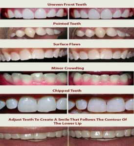 Reshaping in Teeth - Realtooth , Dentist in Lucknow