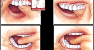 Teeth replacement in lucknow