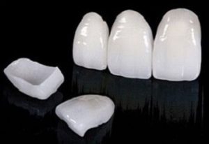 Veneers Laminate - Realtooth , Best Dentist in Lucknow