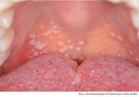 small vesicles - Realtooth