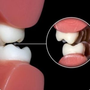 teeth replacement in lucknow