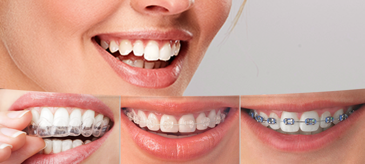 CROOKED TEETH? STOP HIDING BEHIND A SHY SMILE AND OPEN WIDE