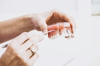 Worried About Dental Implants- Meet us !!!