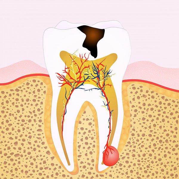 Signs That You Might Need Root Canal Treatment