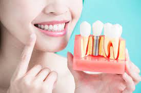 Single Visit Dentistry Solution in Lucknow