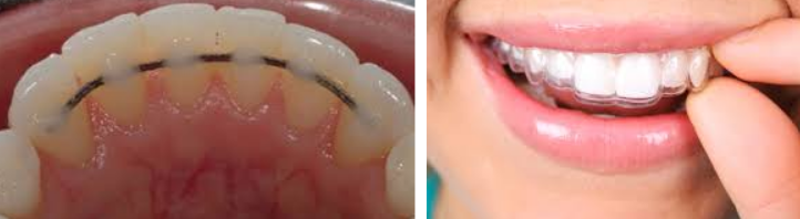 Dental Implant vs Bridge: Which Is Better in 2026?